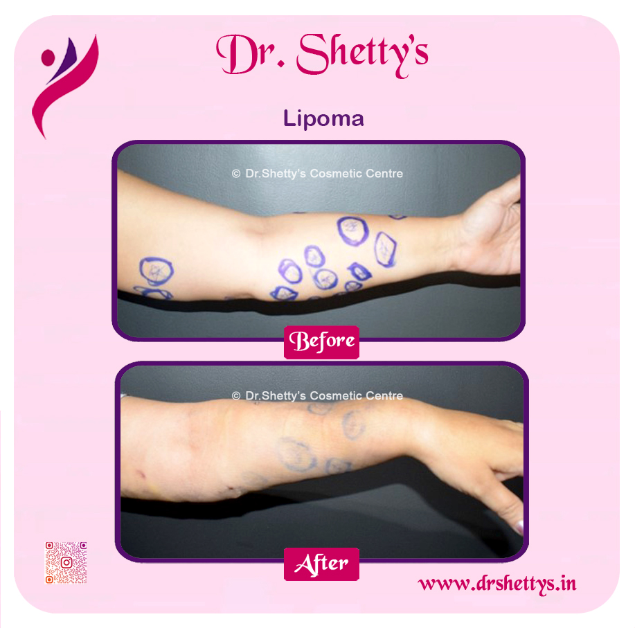 Multiple Lipoma Treatment 18