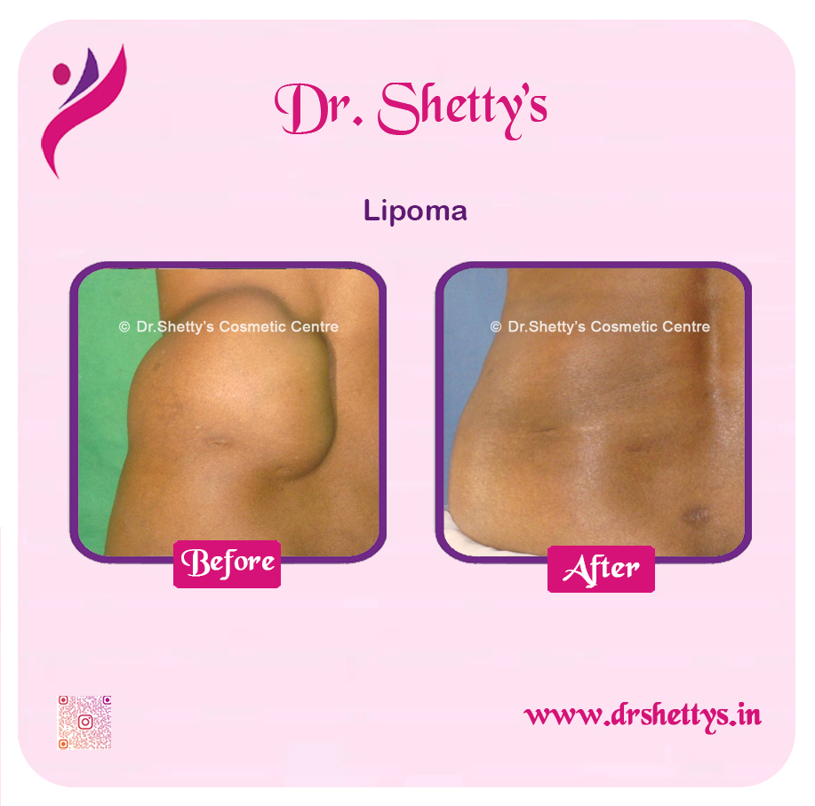 Multiple Lipoma Treatment 19