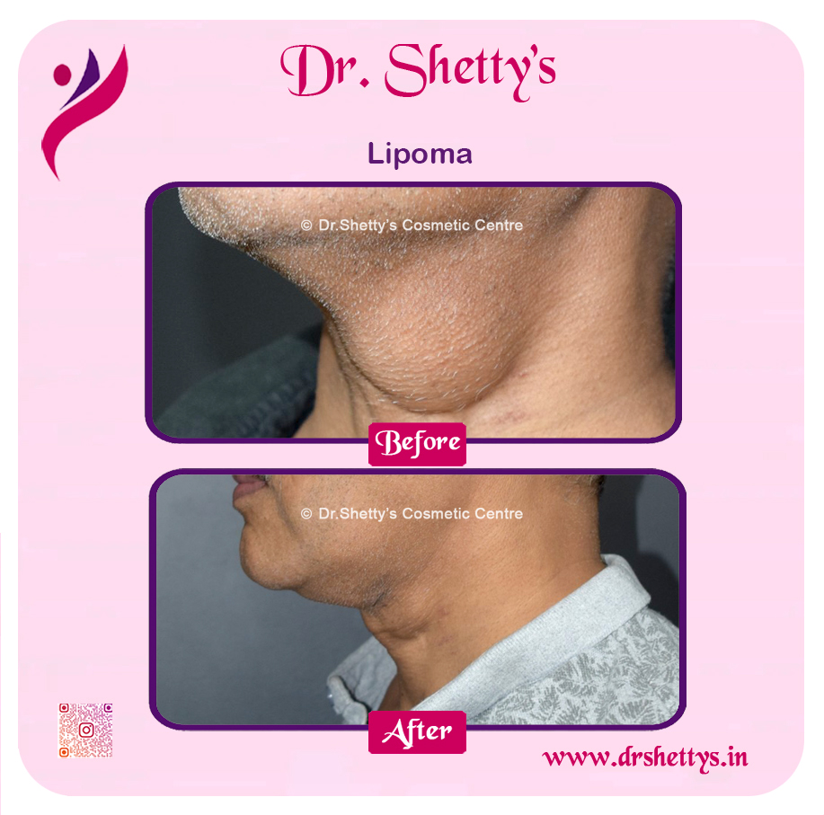 Multiple Lipoma Treatment 2
