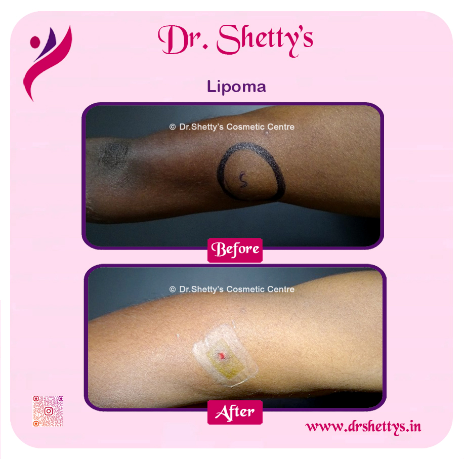 Multiple Lipoma Treatment 20
