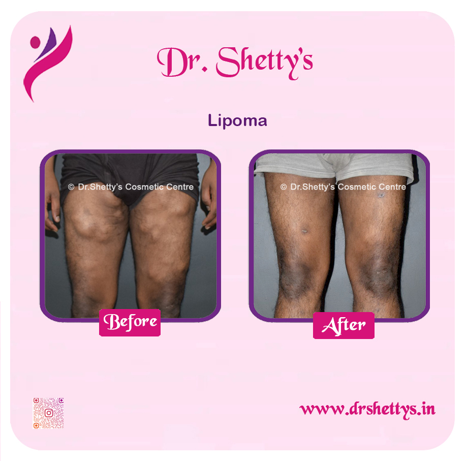 Multiple Lipoma Treatment 21