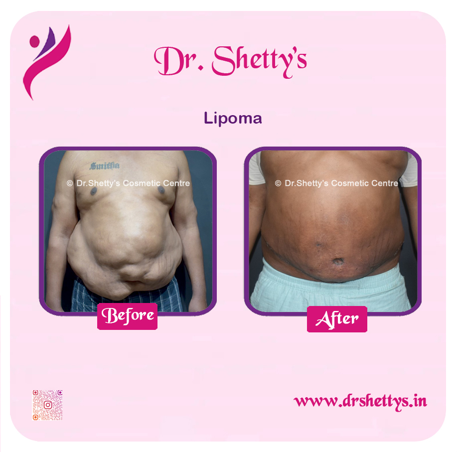 Multiple Lipoma Treatment 22