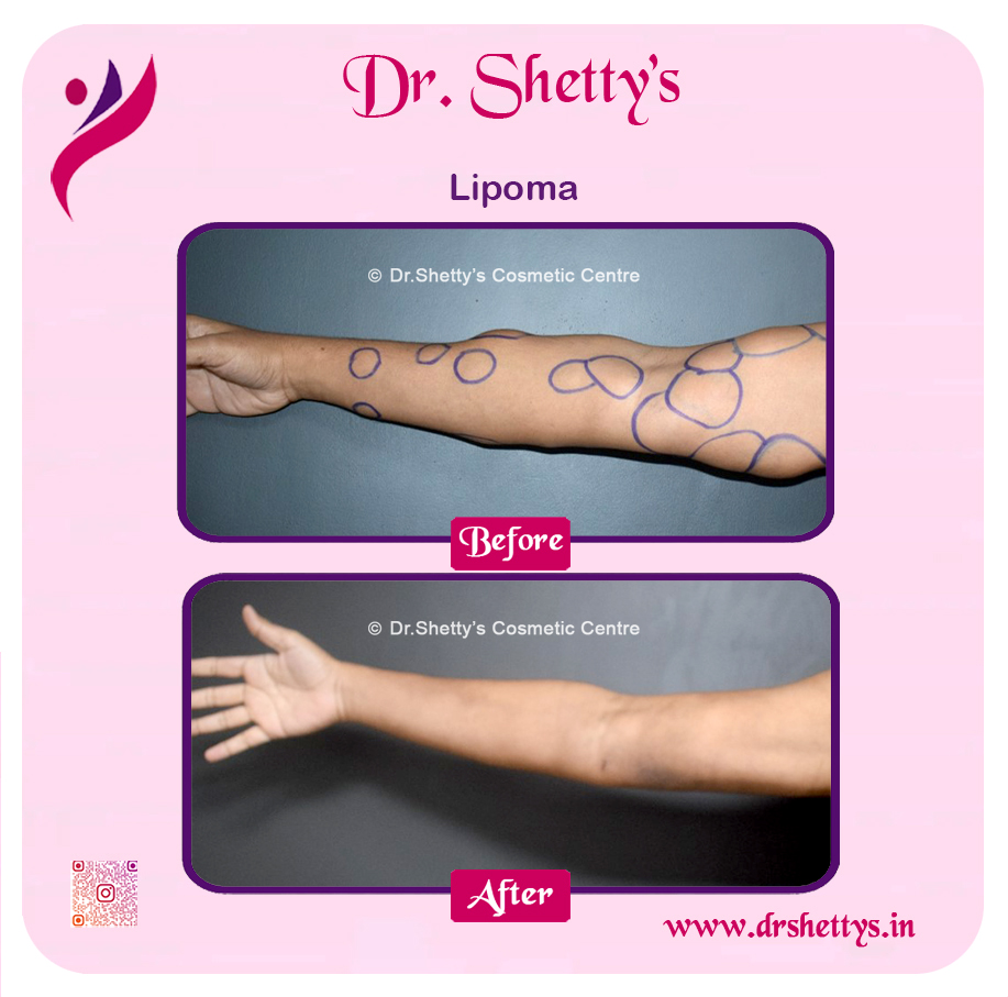 Multiple Lipoma Treatment 23