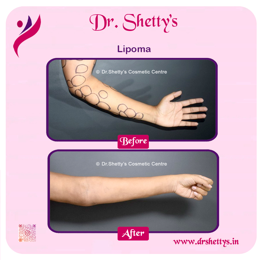 Multiple Lipoma Treatment 24