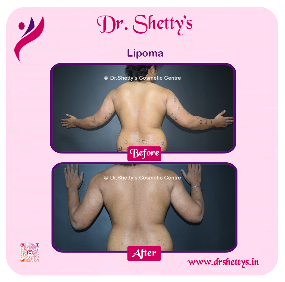 Multiple Lipoma Treatment 25