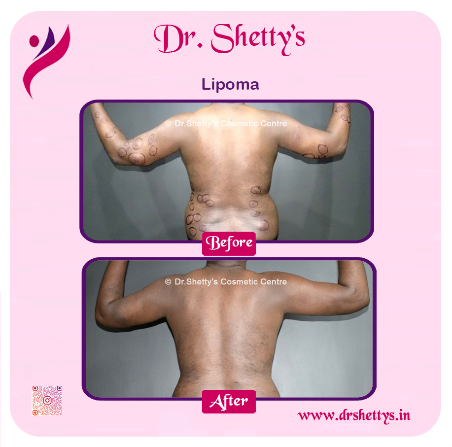 Multiple Lipoma Treatment 26