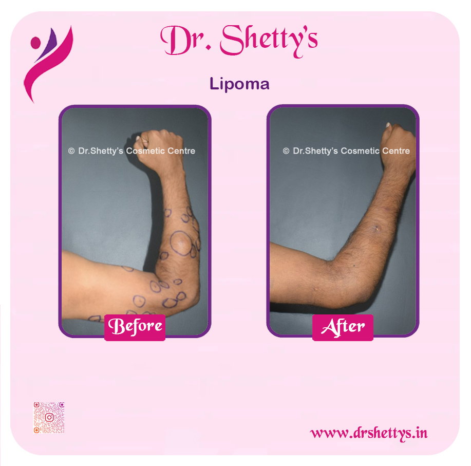 Multiple Lipoma Treatment 27