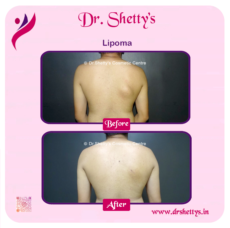 Multiple Lipoma Treatment 28
