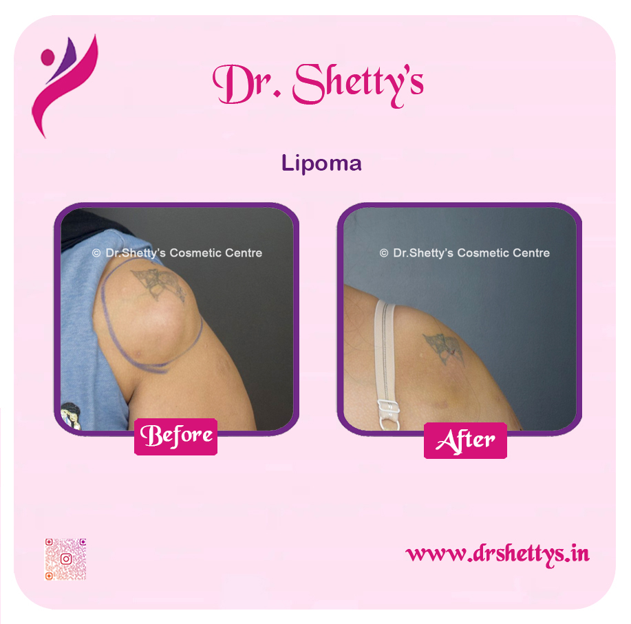 Multiple Lipoma Treatment 29