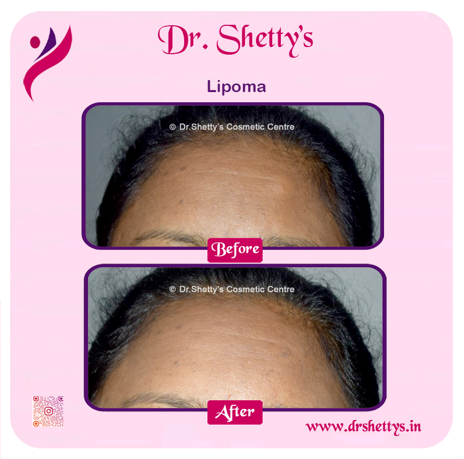 Multiple Lipoma Treatment 3