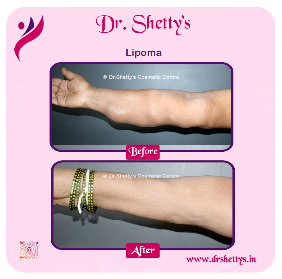 Multiple Lipoma Treatment 30