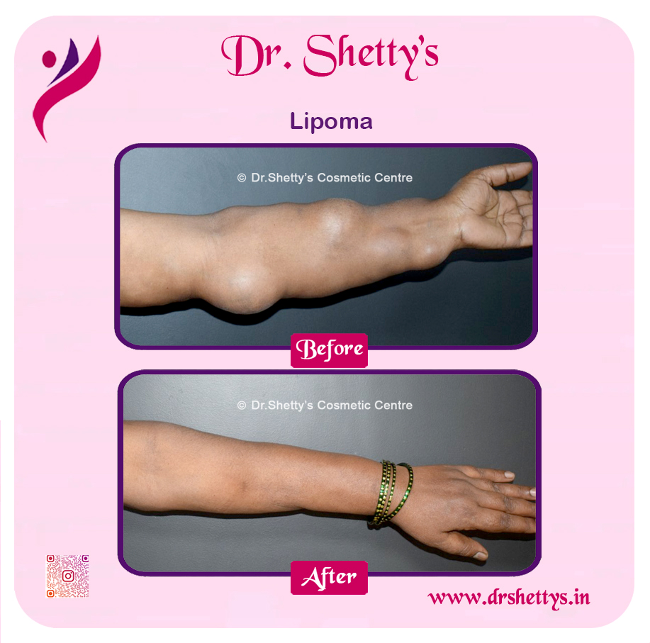 Multiple Lipoma Treatment 31