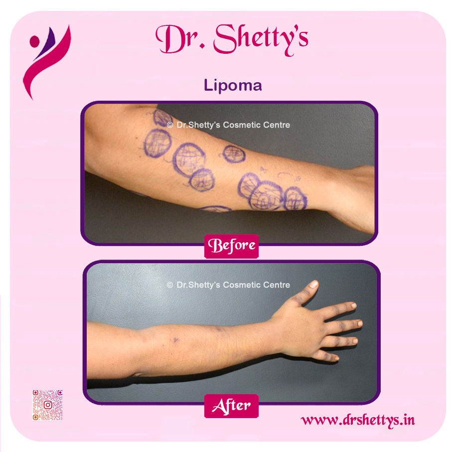 Multiple Lipoma Treatment 32
