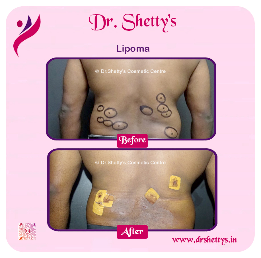Multiple Lipoma Treatment 33