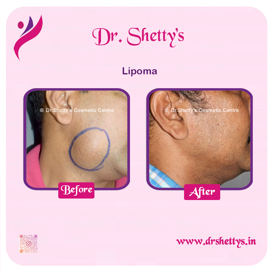 Multiple Lipoma Treatment 34