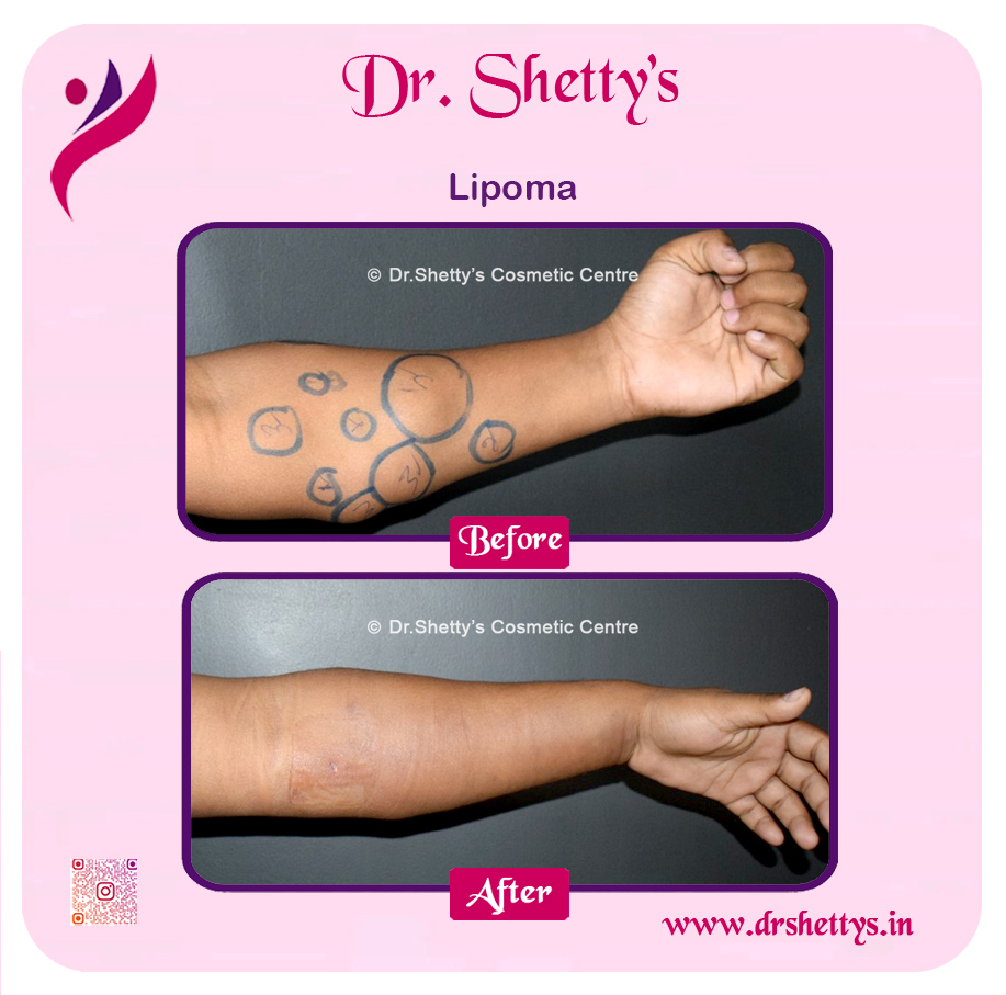 Multiple Lipoma Treatment 35