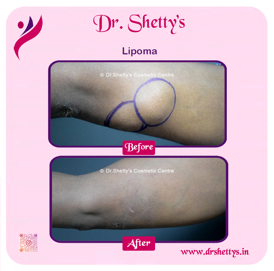 Multiple Lipoma Treatment 36