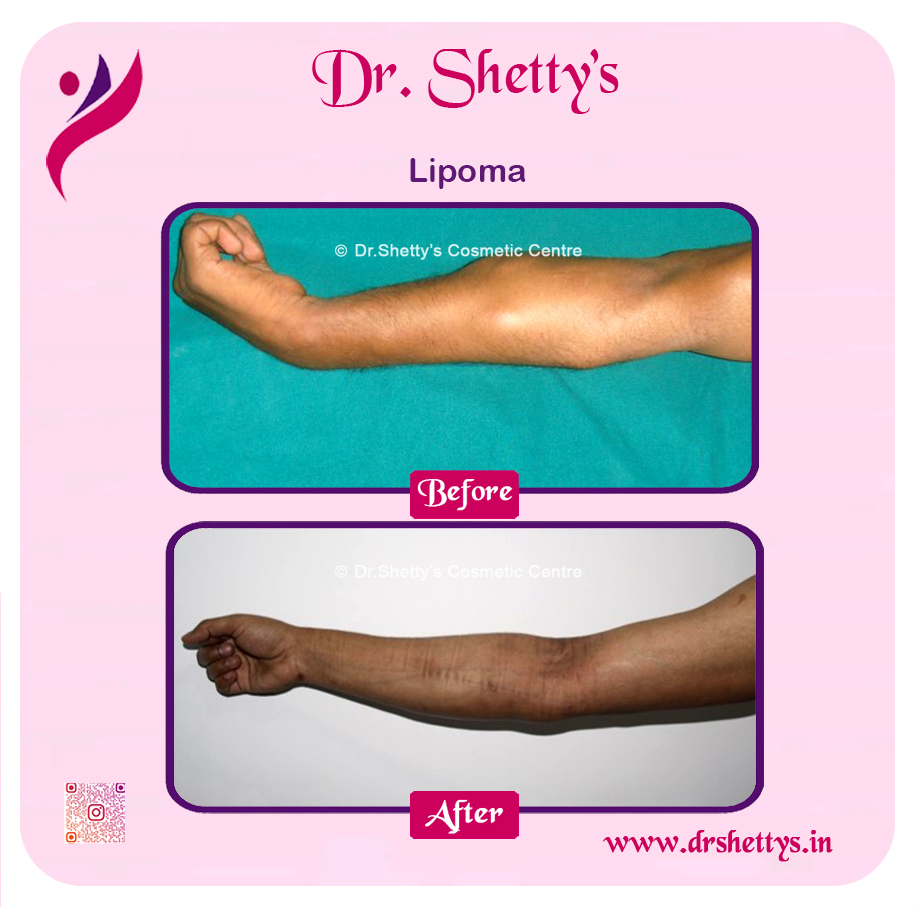 Multiple Lipoma Treatment 37