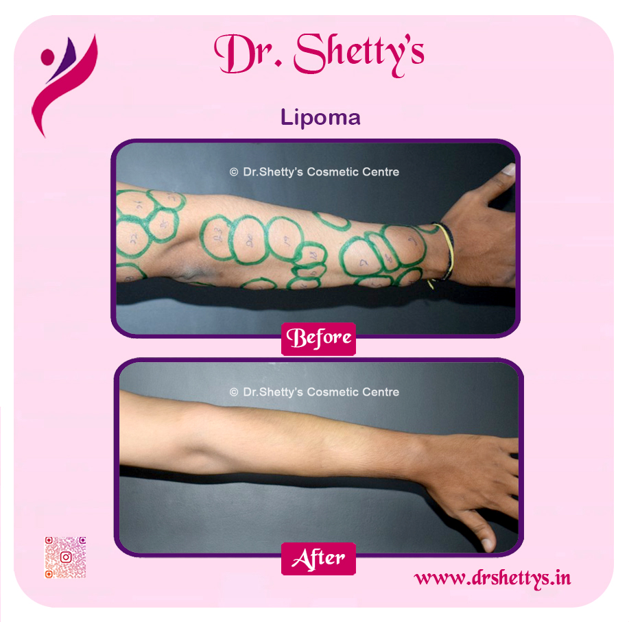 Multiple Lipoma Treatment 39