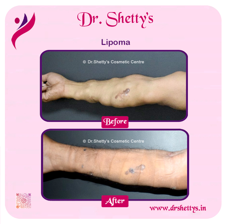 Multiple Lipoma Treatment 40