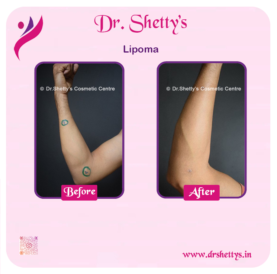 Multiple Lipoma Treatment 41