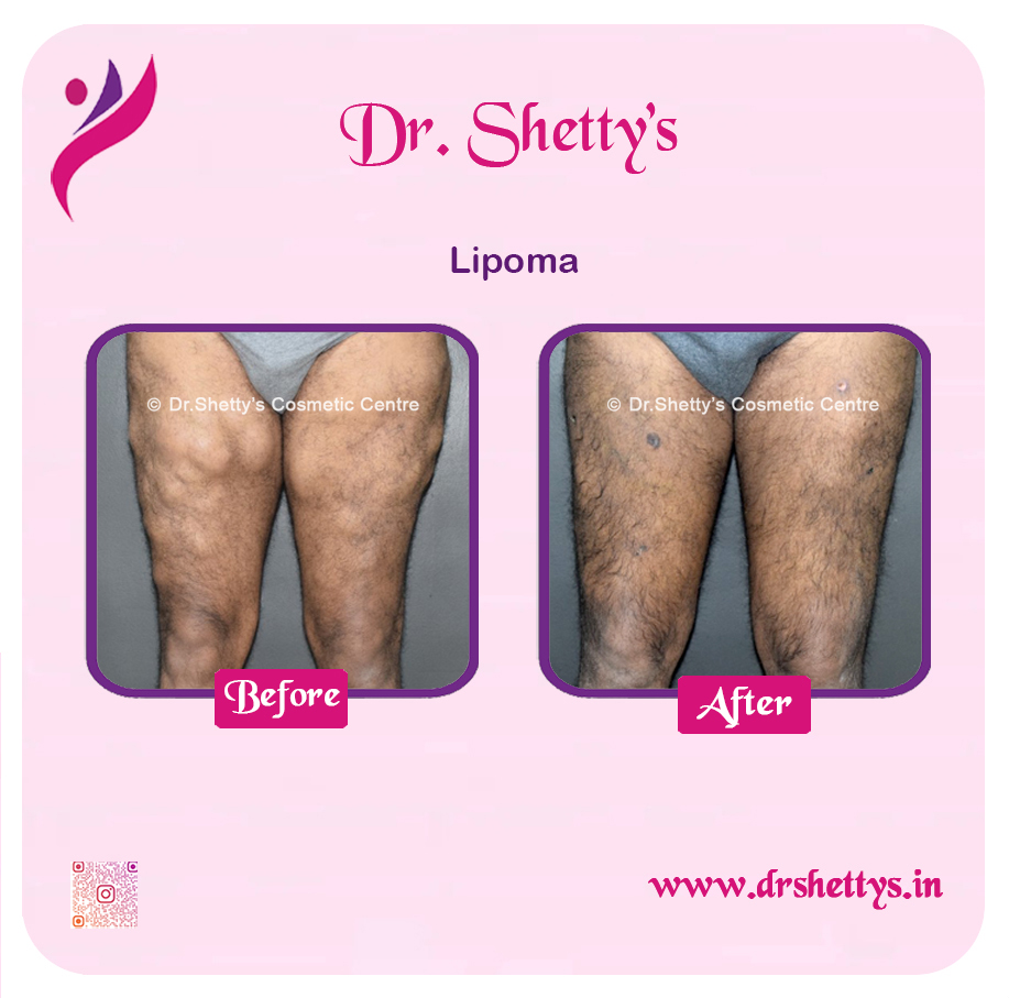 Multiple Lipoma Treatment 42