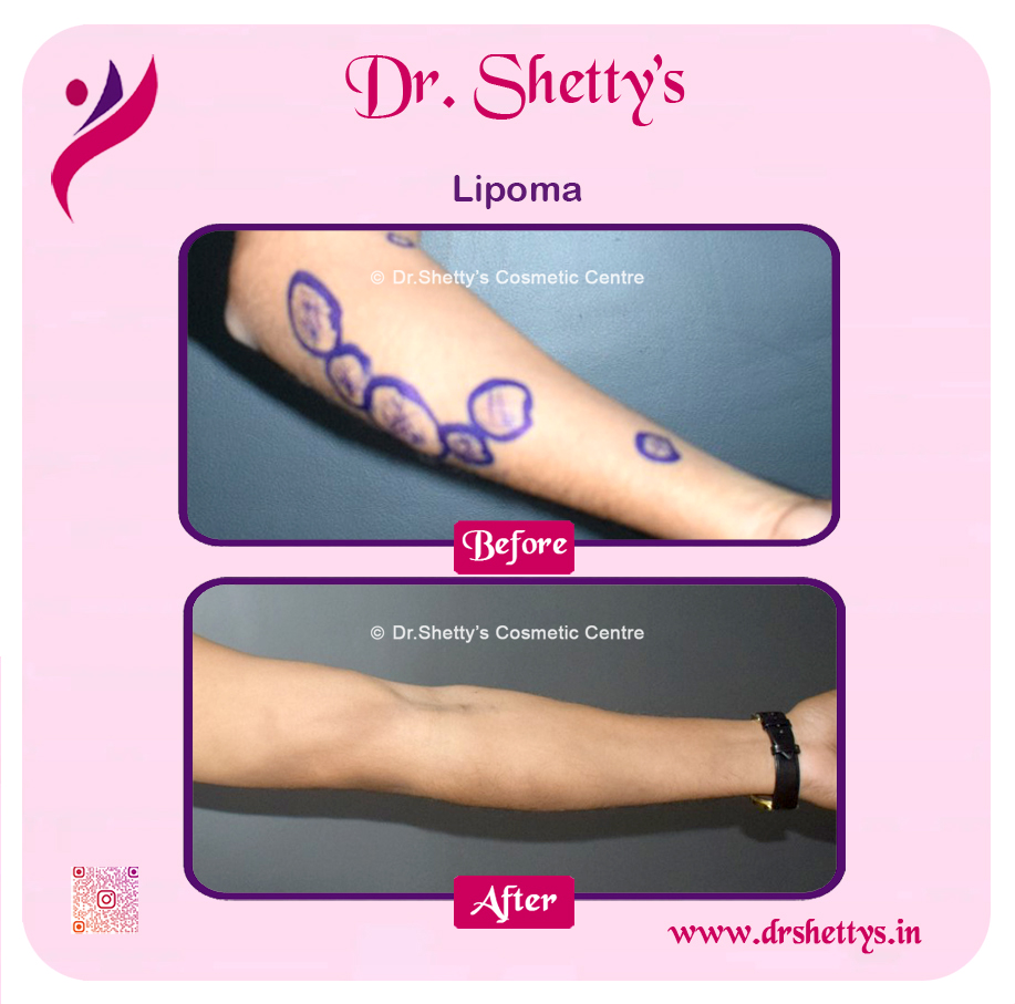 Multiple Lipoma Treatment 43