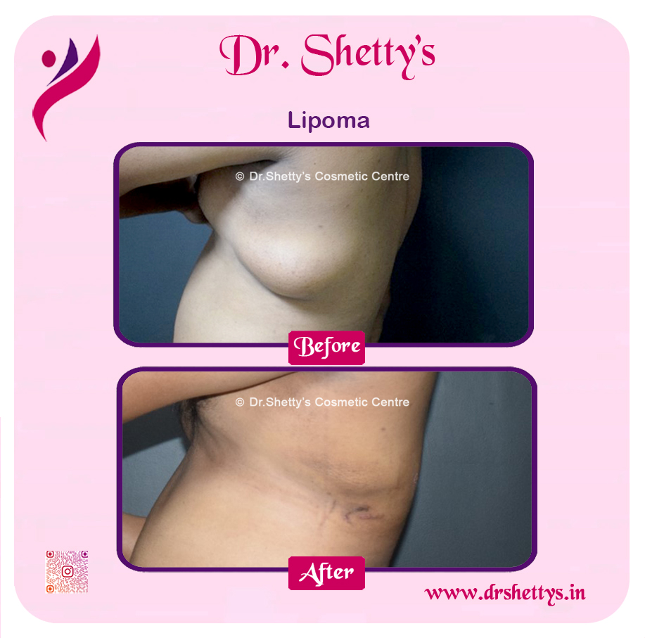 Multiple Lipoma Treatment 44