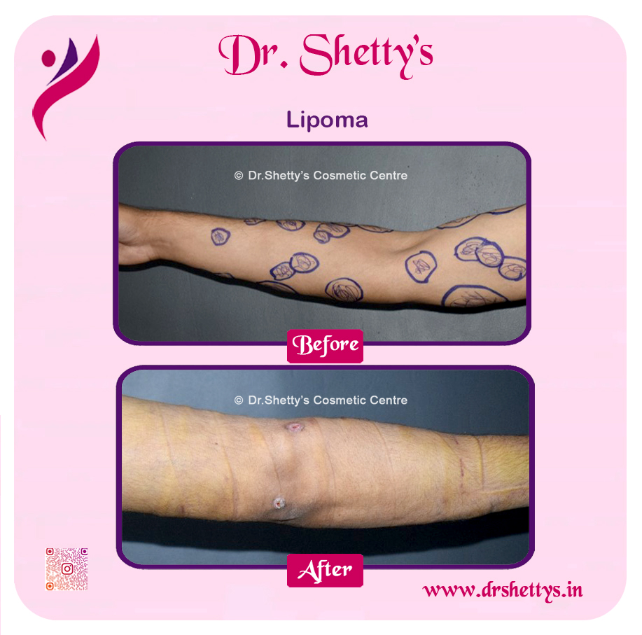 Multiple Lipoma Treatment 45