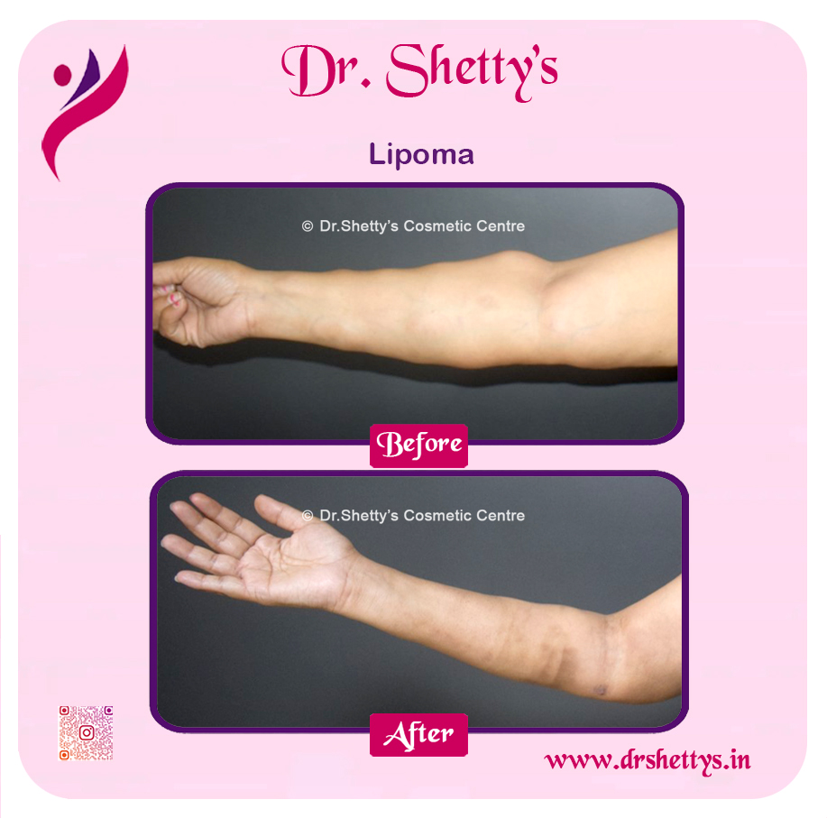 Multiple Lipoma Treatment 46
