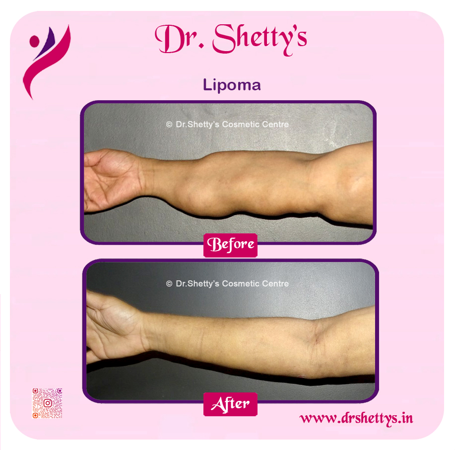 Multiple Lipoma Treatment 47