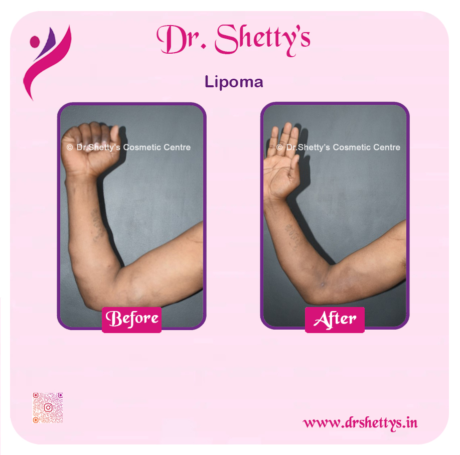 Multiple Lipoma Treatment 48