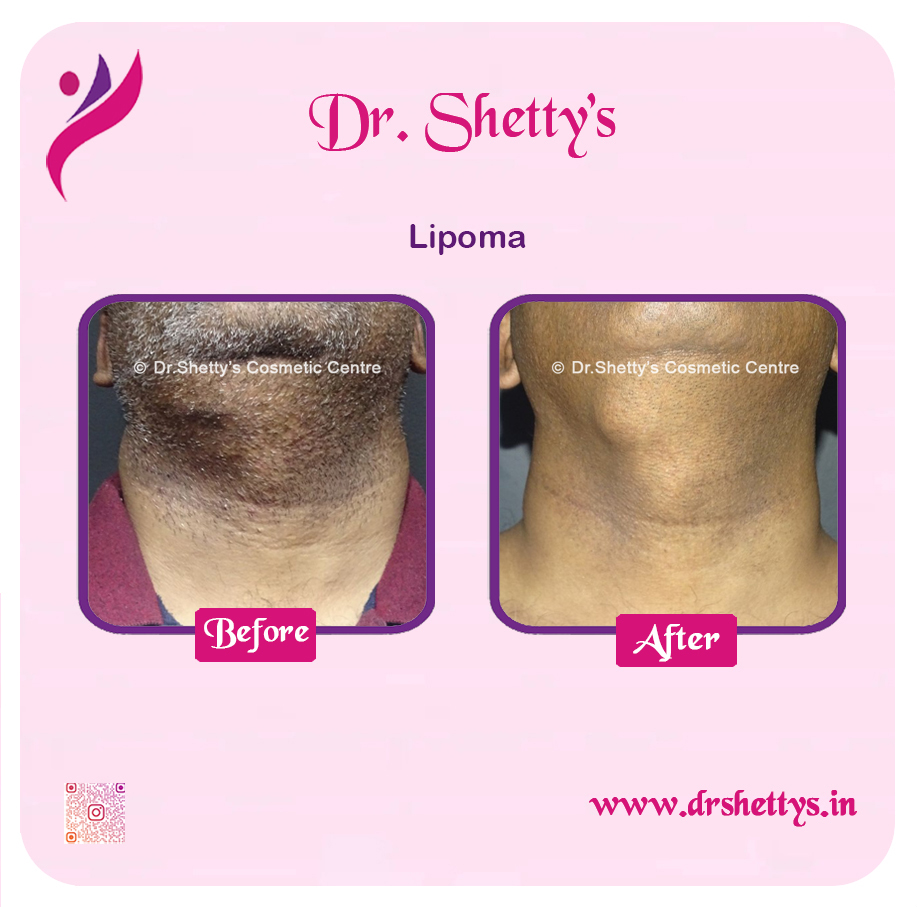 Multiple Lipoma Treatment 49