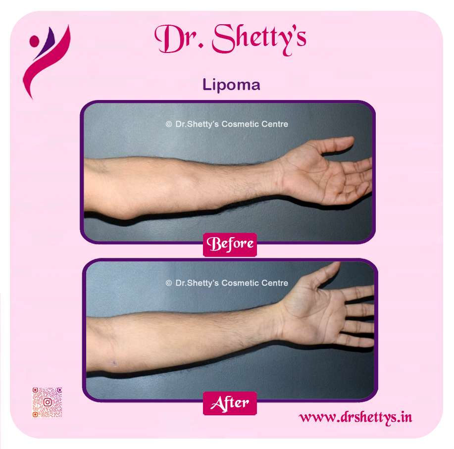 Multiple Lipoma Treatment 5