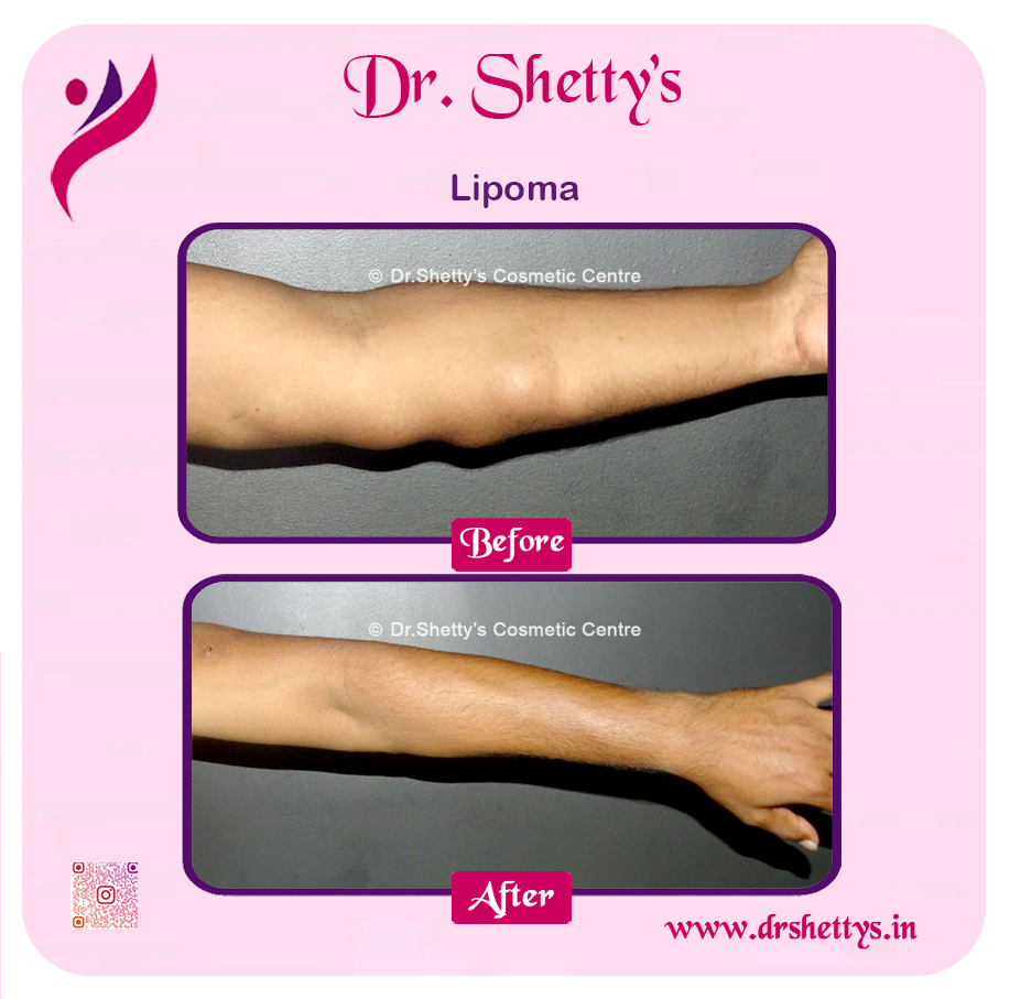 Multiple Lipoma Treatment 50