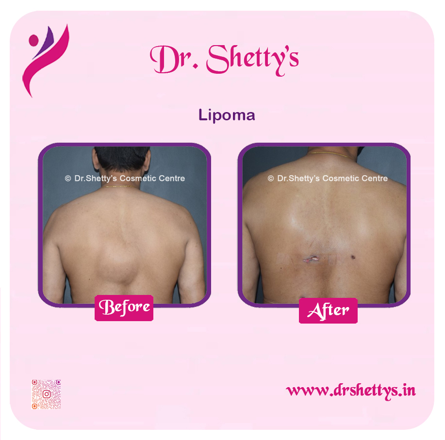 Multiple Lipoma Treatment 51
