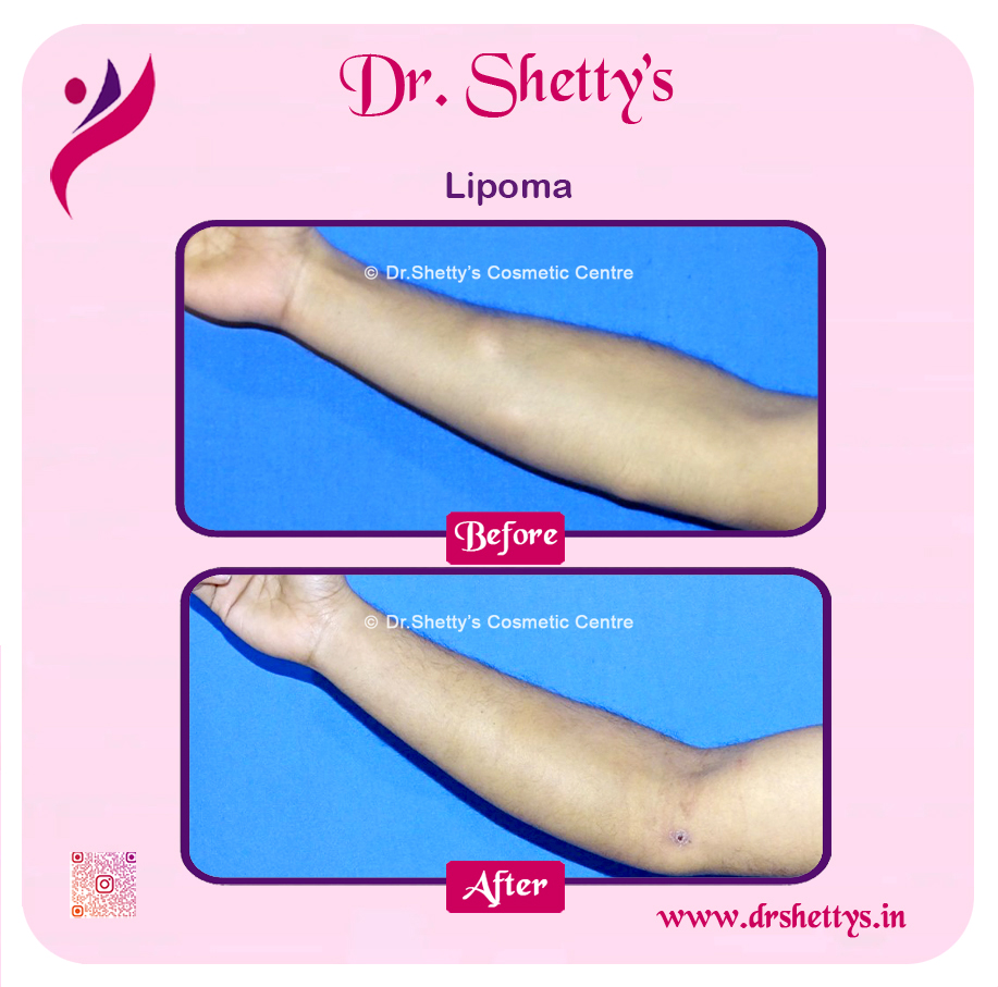 Multiple Lipoma Treatment 52