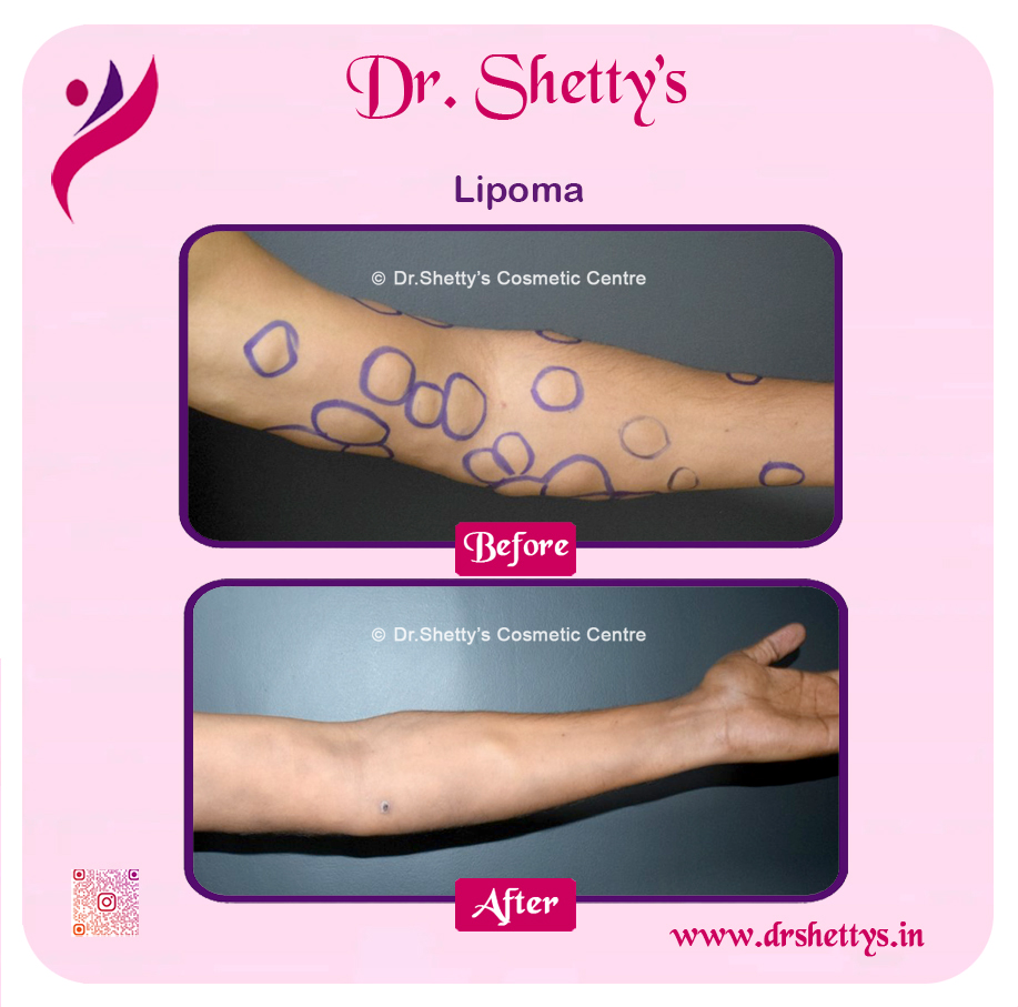 Multiple Lipoma Treatment 53