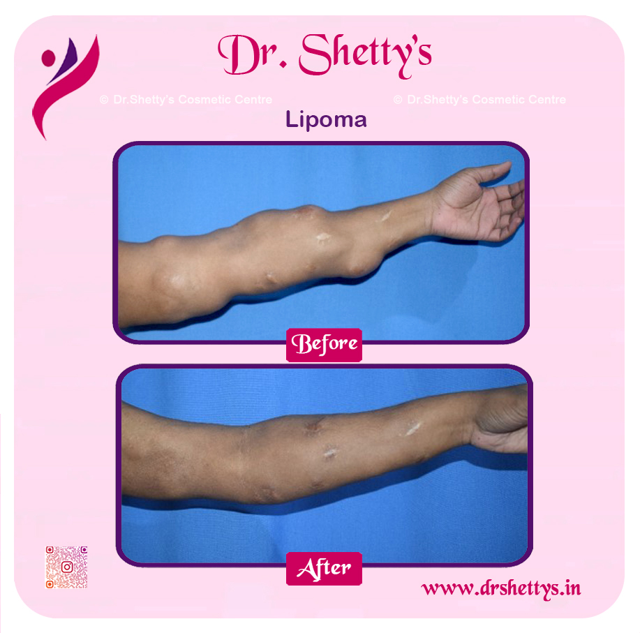 Multiple Lipoma Treatment 54