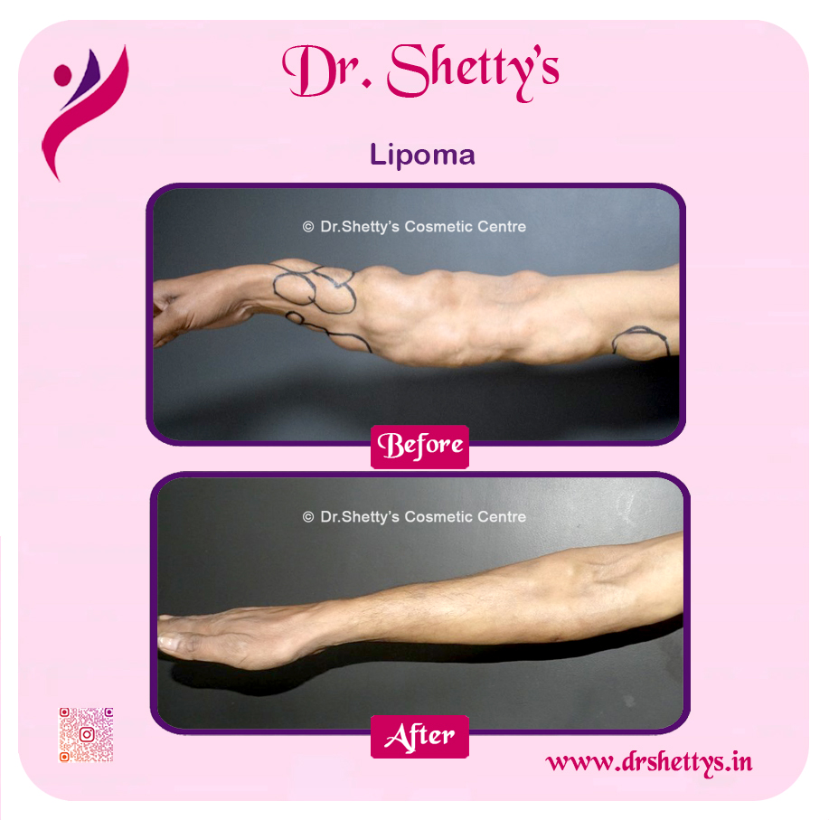 Multiple Lipoma Treatment 6