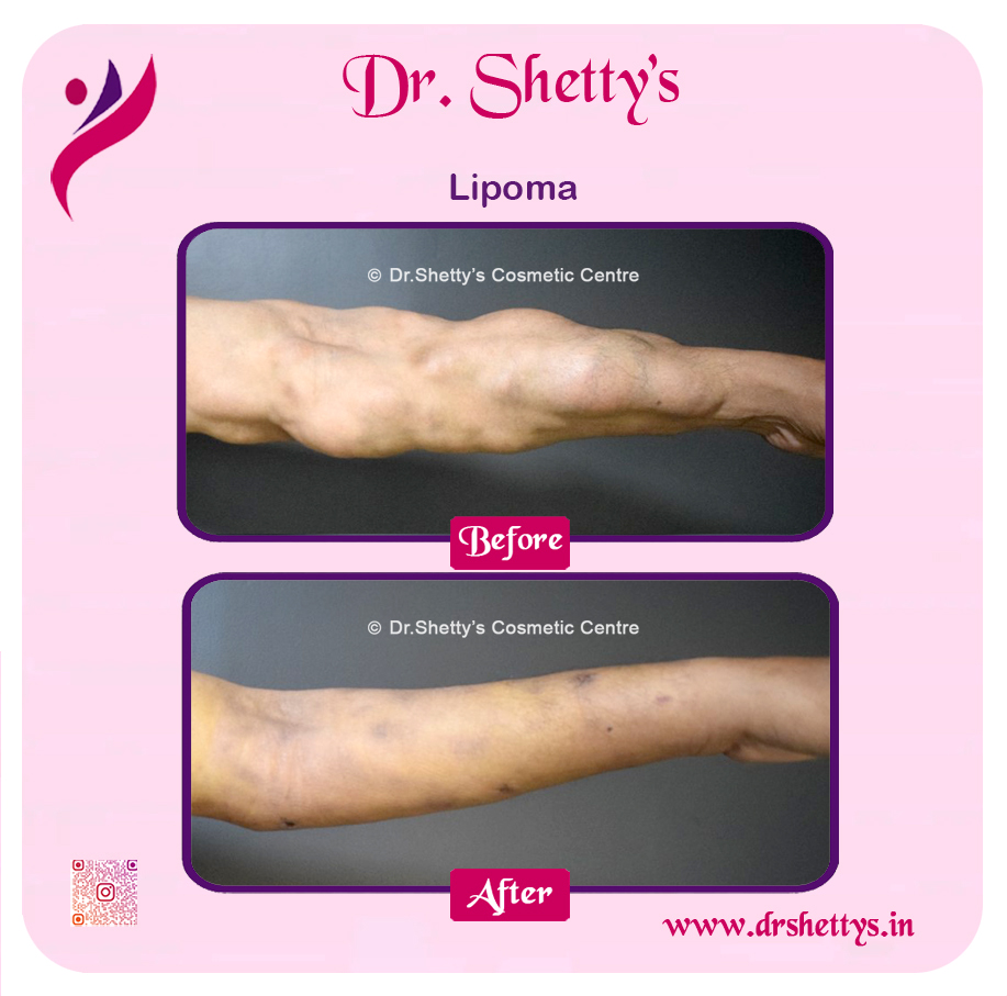 Multiple Lipoma Treatment 7