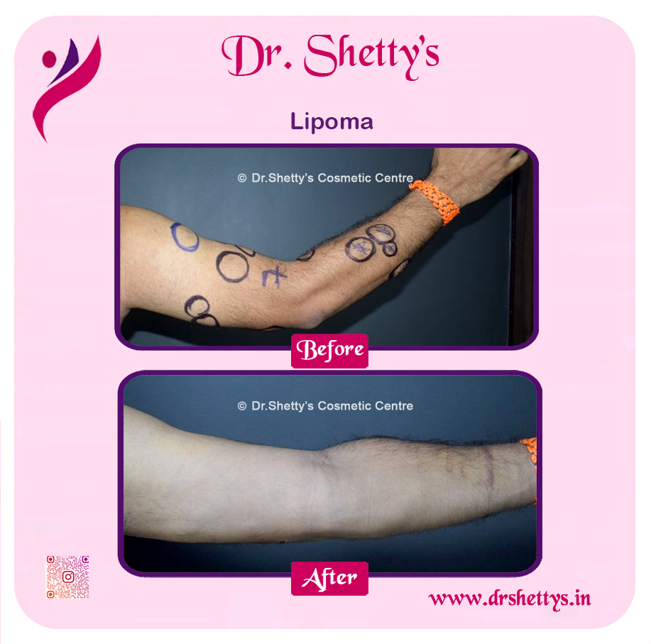 Multiple Lipoma Treatment 8