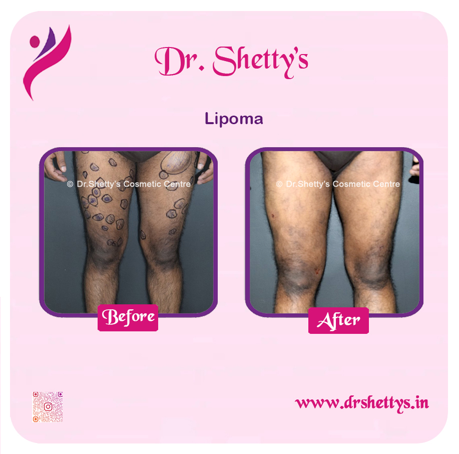 Multiple Lipoma Treatment 9