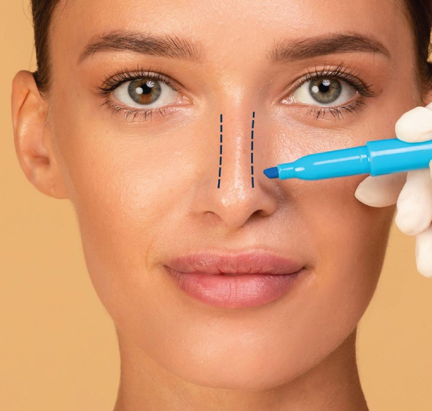 Open Rhinoplasty