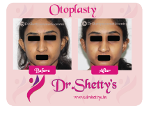 Otoplasty