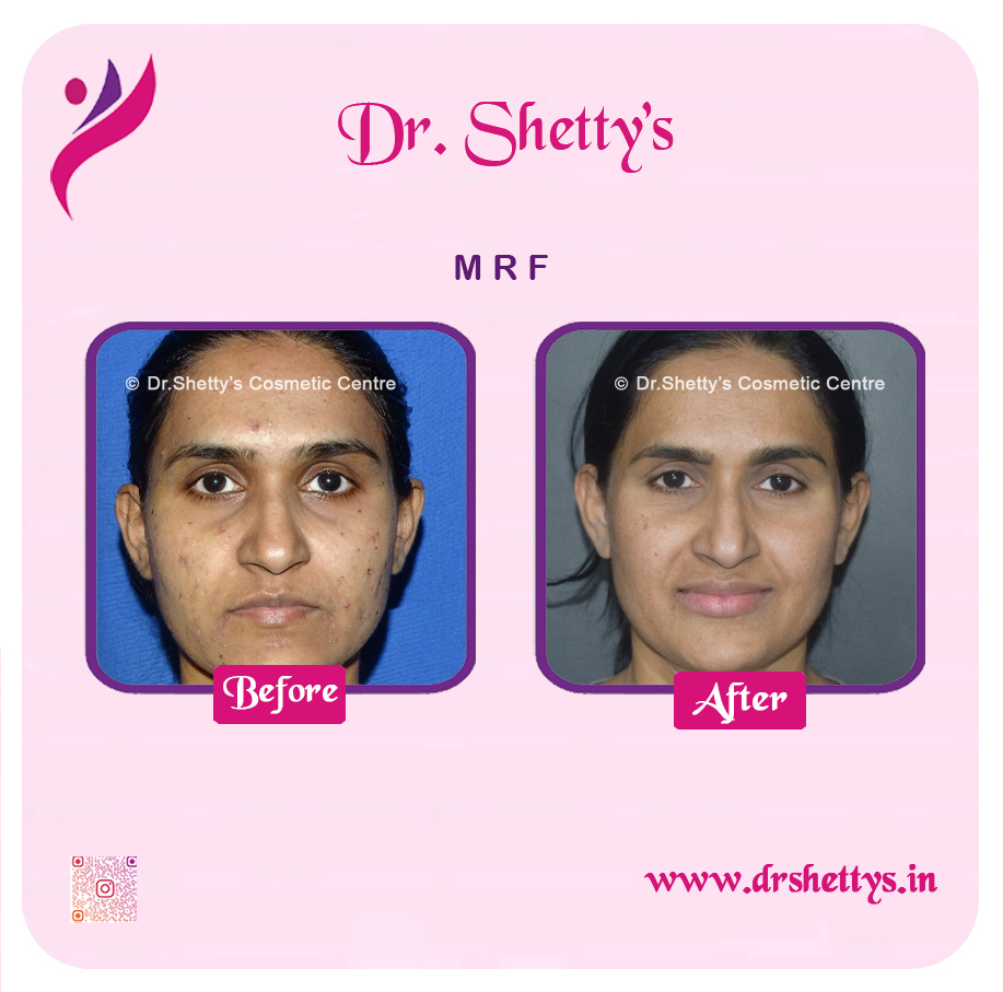Pimple and Acne Scar Treatment 1