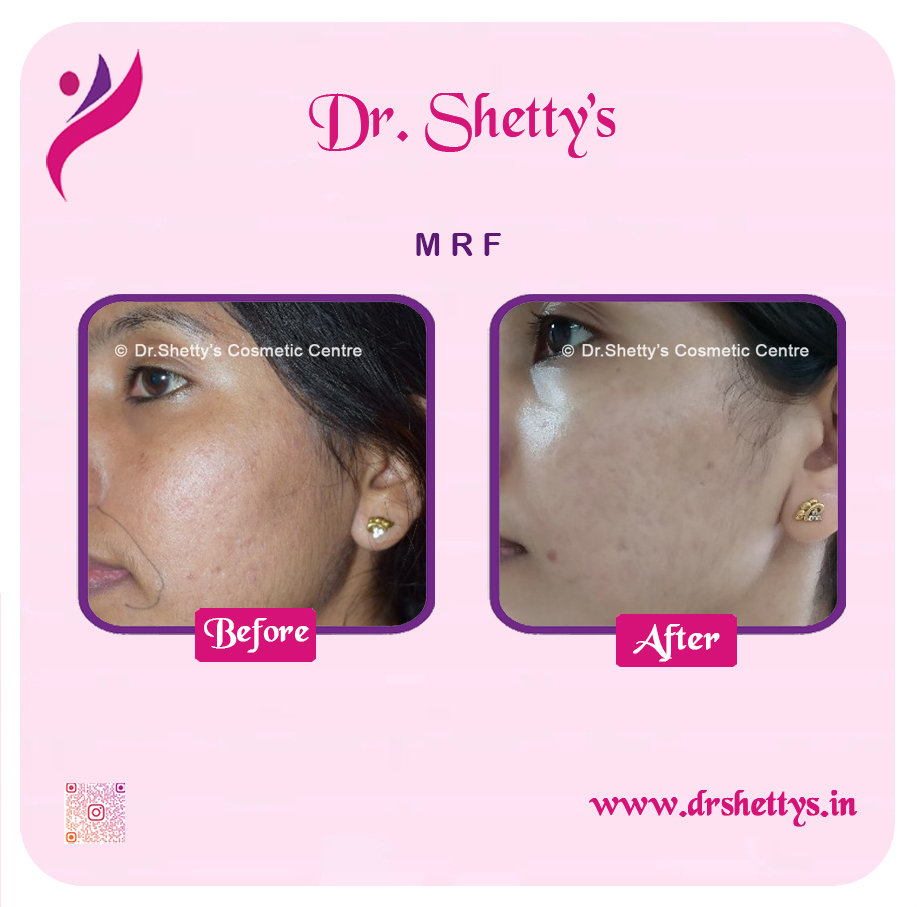 Pimple and Acne Scar Treatment 11