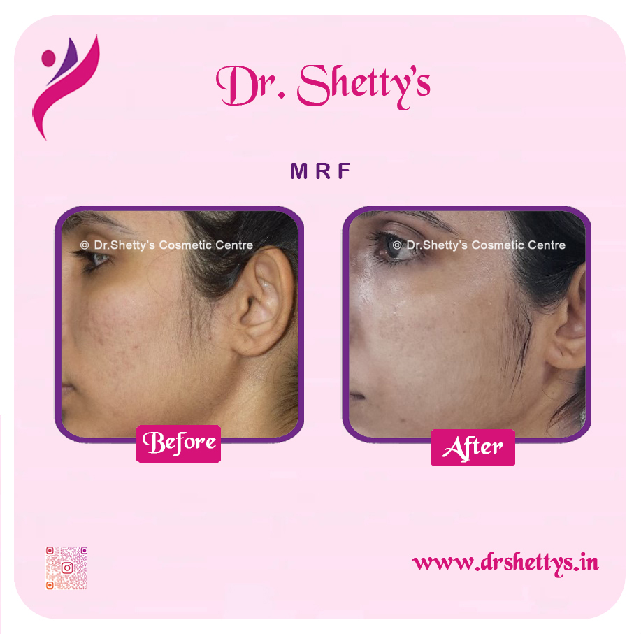 Pimple and Acne Scar Treatment 12