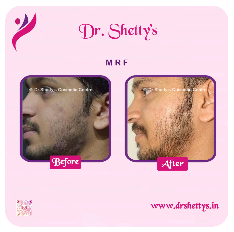 Pimple and Acne Scar Treatment 13