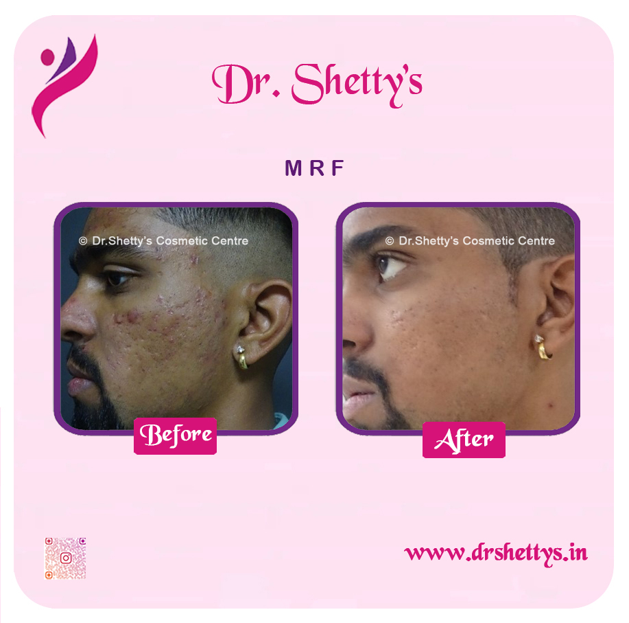 Pimple and Acne Scar Treatment 14